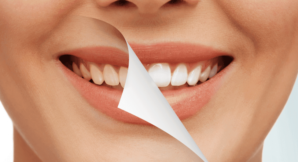 Teeth Whitening: Professional vs. At-Home Treatments