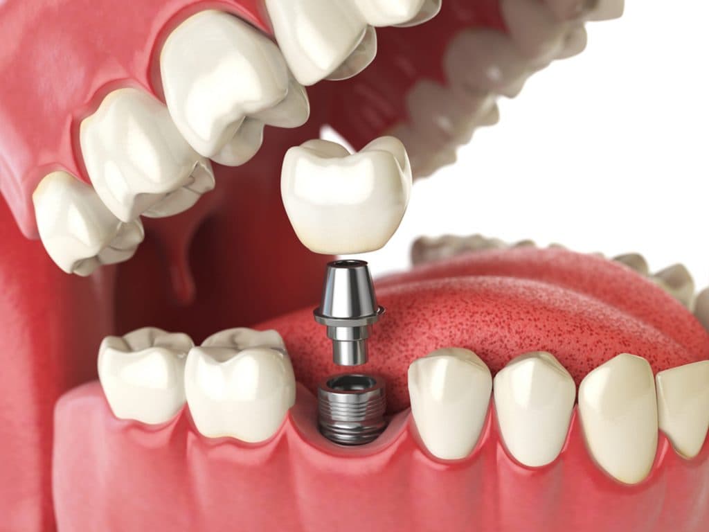 Understanding Dental Implants: A Complete Guide