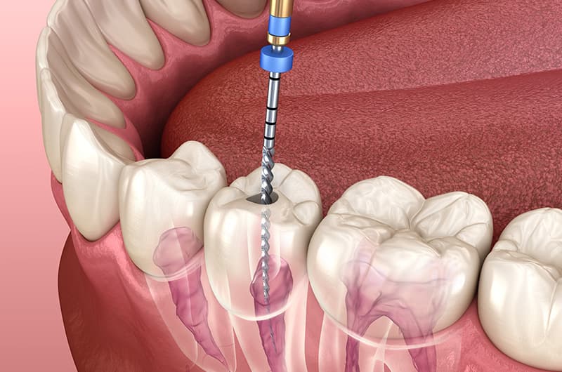 Root Canal Treatment: Myths vs. Facts