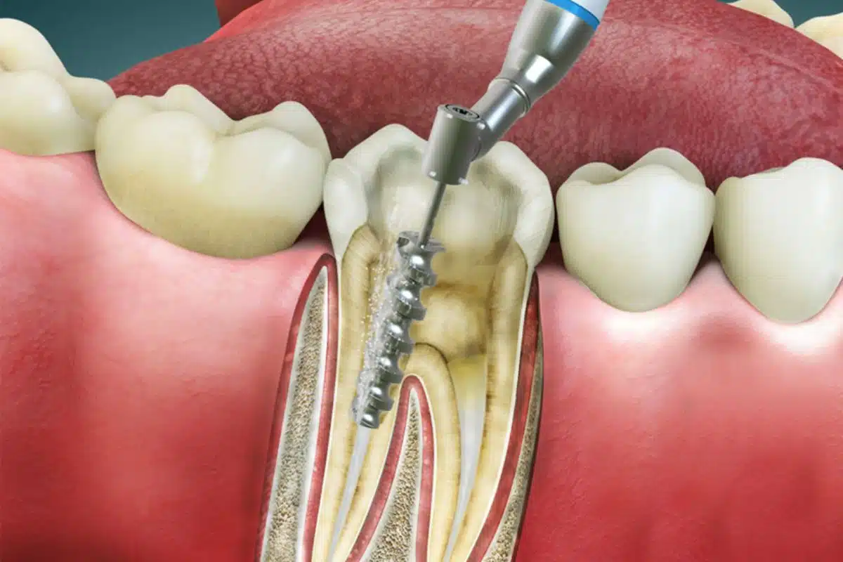 Root Canal Treatment (RCT)