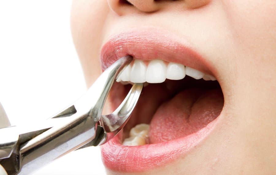 Tooth Extraction